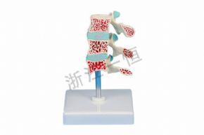 生物及醫(yī)療模型SM-M008骨質(zhì)疏松模型